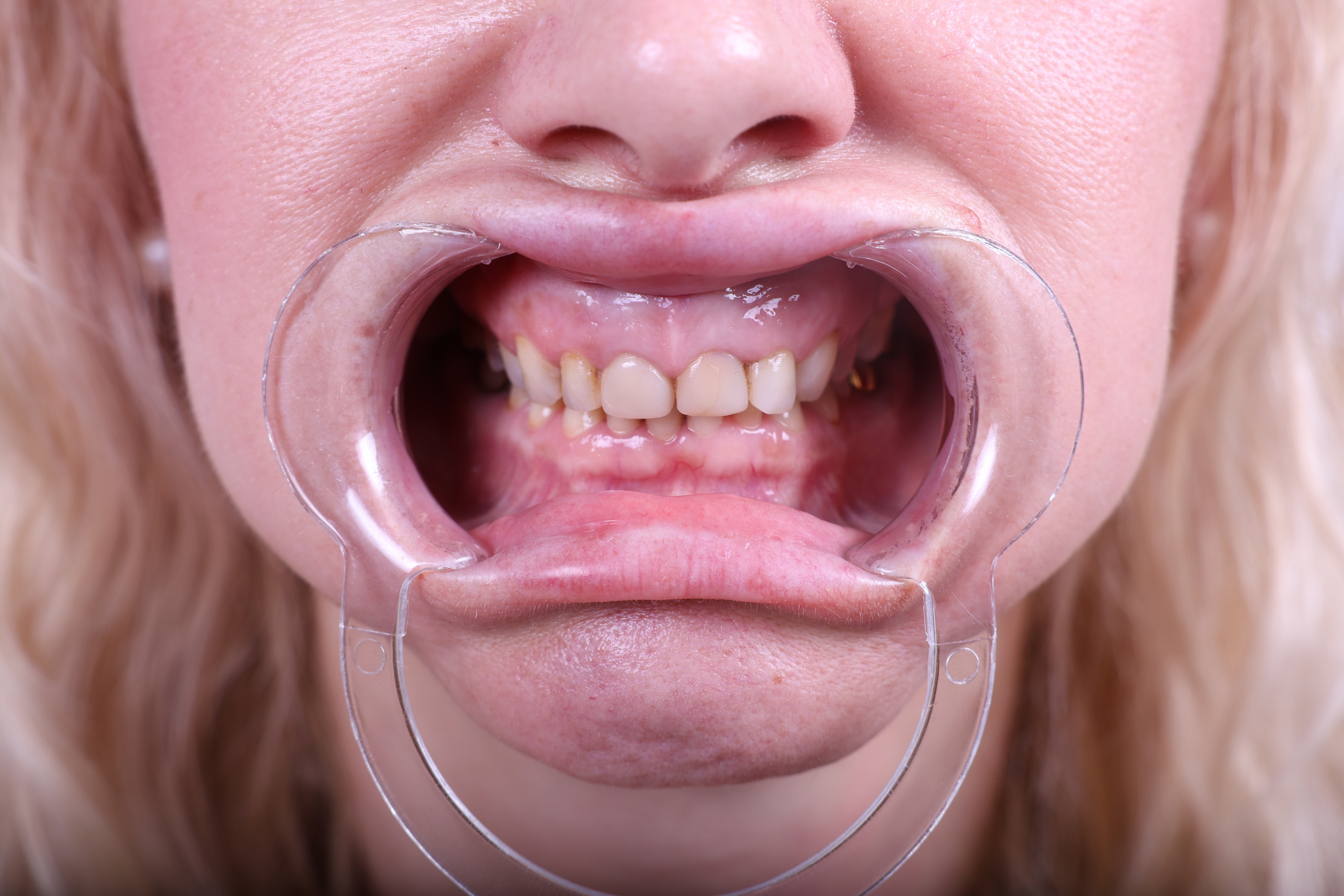 Before Zirconia Crown Treatment